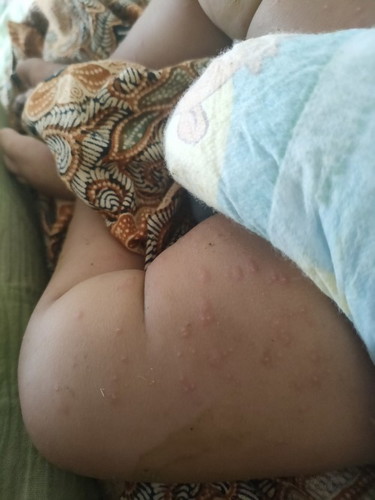 Bun rekomendasi obat/salep buat bayi umur 2 bulan gatal2 karena alergi?