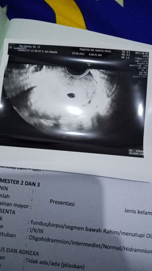 8week kantung janin kecil