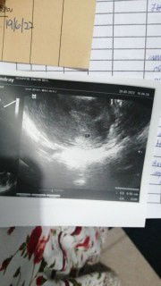 KANDUNGAN SELEPAS ECTOPIC (KANDUNGAN LUAR RAHIM)