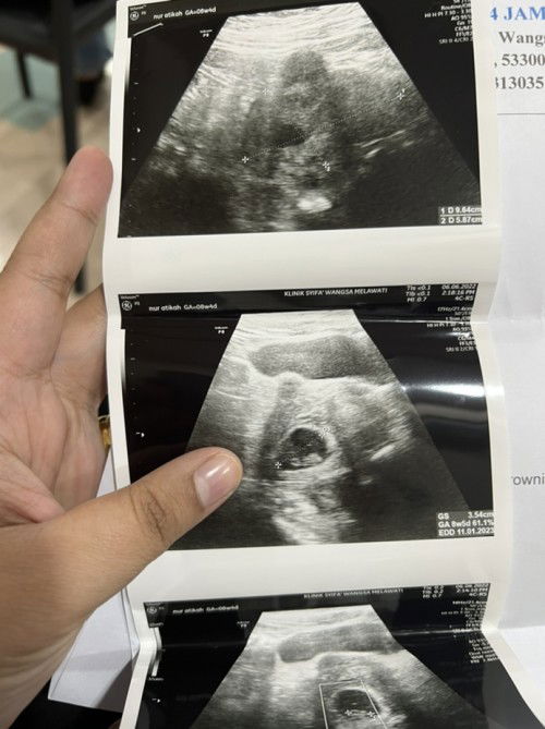 Tiada denyutan Jantung