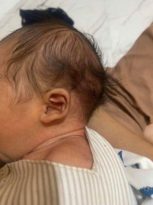 Pipi leher besar sebelah