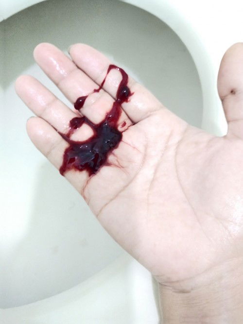 เราท้องได้10สัปดาห์มีเลือดออก