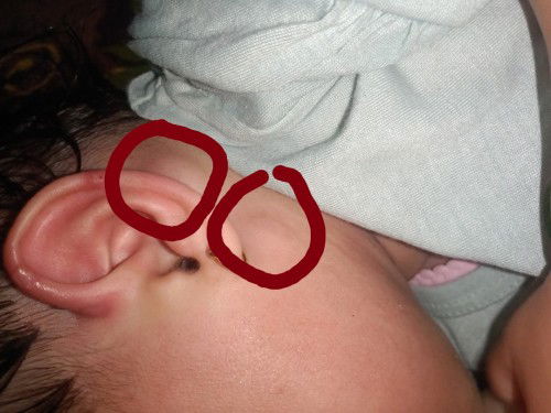 Benjolan di belakang dan bawah telinga bayi