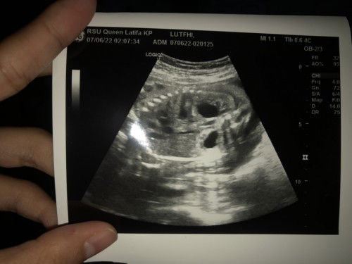 Uk 25mgu divonis polistik ginjal