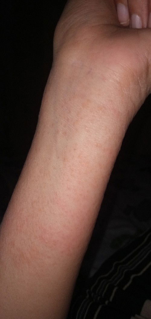 Ruam gatal saat hamil 14w