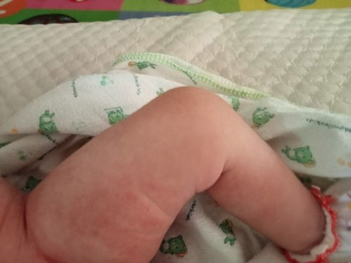 น้องอายุได้13วันมีผื่นแดงๆเต็มไปหมด