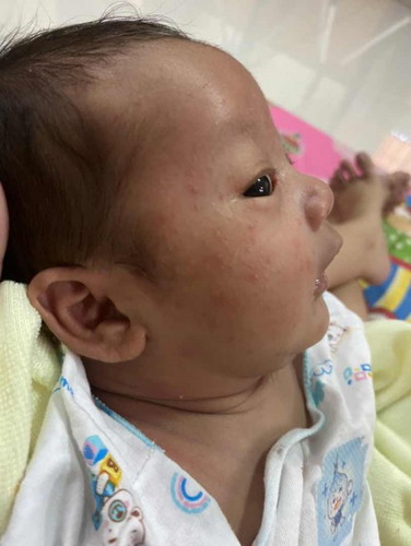 ลูกอายุ 22 วัน ผื่นขึ้นเต็มหน้าใช้อะไรดี อยากให้หาย สงสารมาก