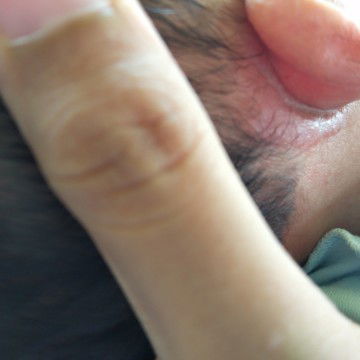 Merah2 pada tubuh bayi