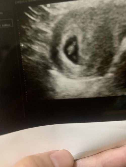 Bpjs untuk control usg pertama