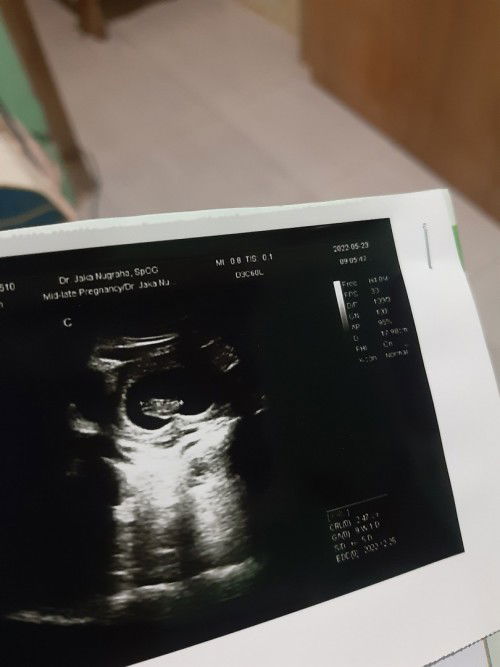 Hasil usg 9minggu , ada yg sama ga bun masih terlihat seperti di foto ini?