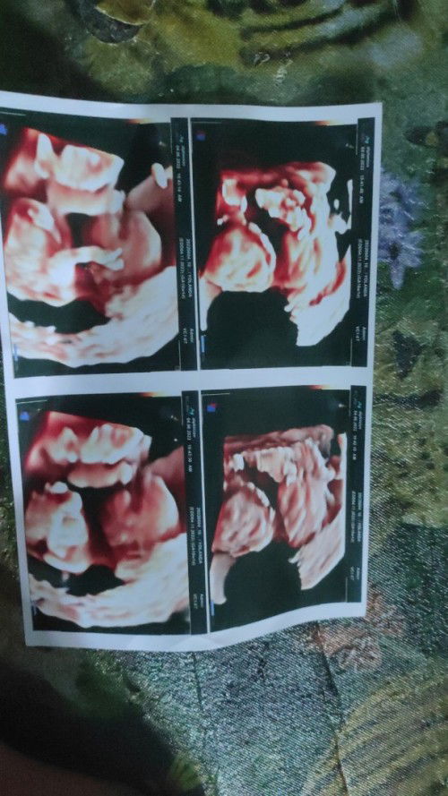 Tentang kehamilan kembar