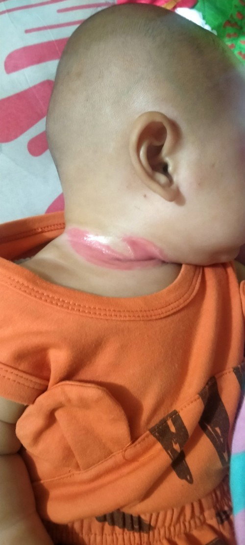 Iritasi kulit pada bayi