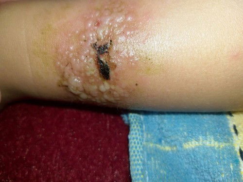 Kaki anak saya melepuh