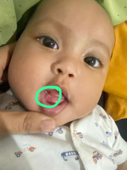 Bercak seperti sariawan