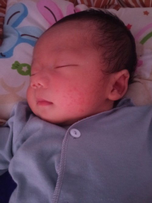 Pipi bintik merah karena kena asi