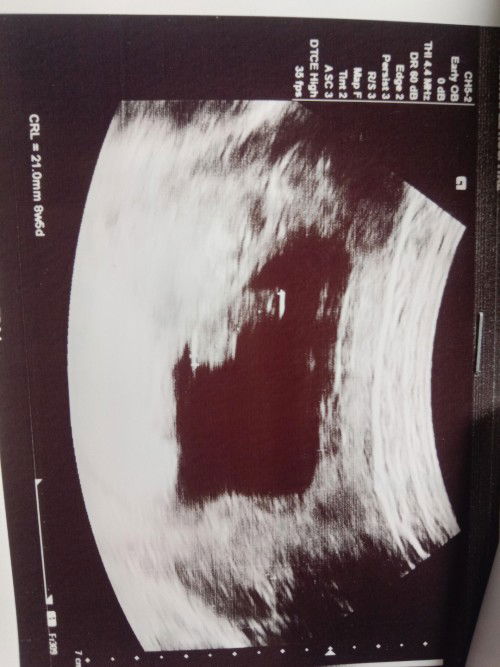 ประจําเดือนมาล่าสุด17ก.พแต่ท้องได้8W+5D