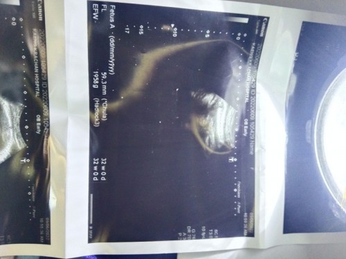 ผลอัลตร้าซาวด์