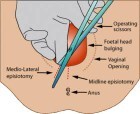 Help me with my Episiotomy Stiches..