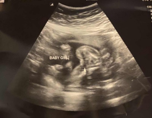Baby girl ke baby boy?