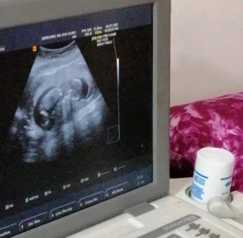 Hindi po ba masikip ung pwesto ni baby? normal lang ba ung amniotic fluid ko?