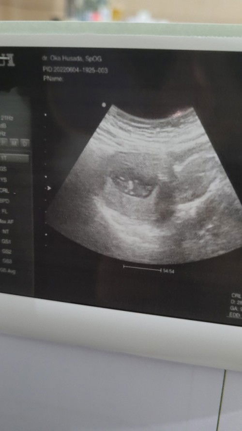 Apakah hamil kembar ?