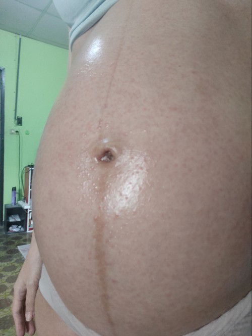 แม่คนไหนเคยมีผื่นแดง