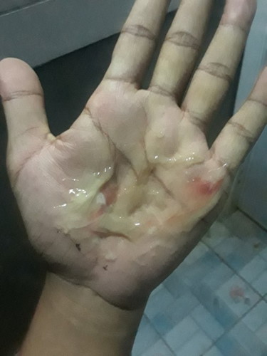 มีมูกเลือดออกแบบนี้ จะคลอดไหม