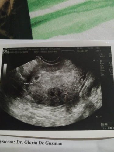 sino ang naka encounter na ng empty sac? Nag develop ba ang embryo sa loob nito?