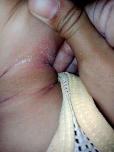 คอน้องเป็นเเบบนี้เป็นเพราะอะไรคะทำยังไงถึงจะหาย  ตรงรักเเร้เเละหว่างขาน้องก็เป็น