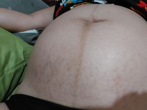 Hi mga mamsh, ftm here and im on way to third trimester. Any recommendations for stretch marks po?