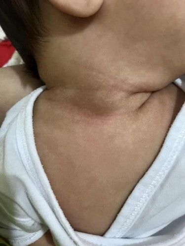 White spots and redness on neck
