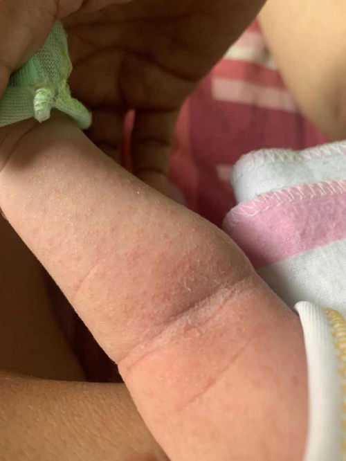 Bruntusan pada kulit bayi