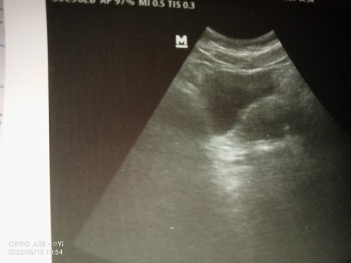 Mom aku mau tanya hpht 27 Maret 2022 ,dan USG 22 mie
kata dokter belum kelihatan janin tapi hamil?