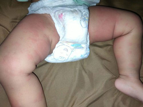 Kulit bayi merah merah