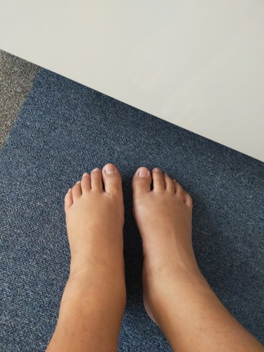 เท้าบวมมาก