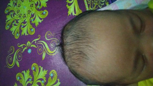 Benjolan dikepala bayi baru lahir