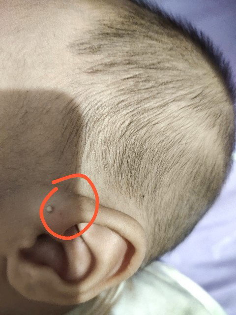 Bun ad yg samaan sprti anak saya ga ya? Keluar cairan dri lubang kecil d atas telinganya