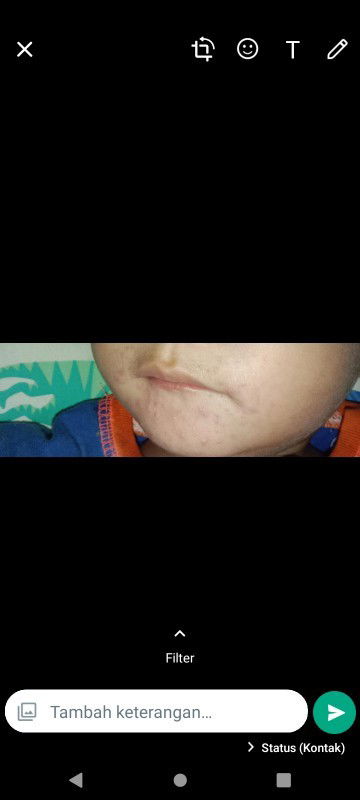 Ruam bintik saat anak demam