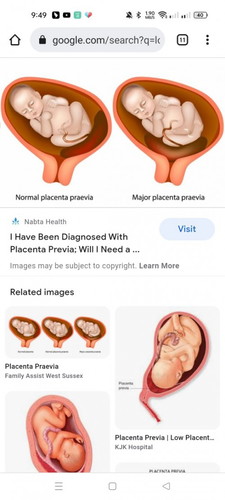 Low laying placenta