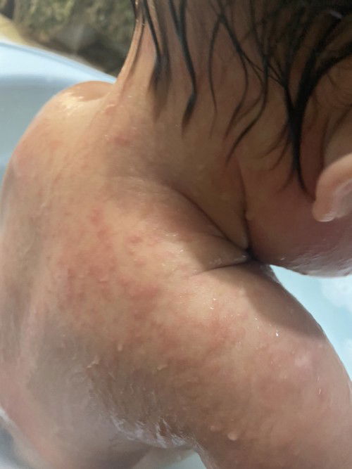 ถามแม่ๆผื่นลูก