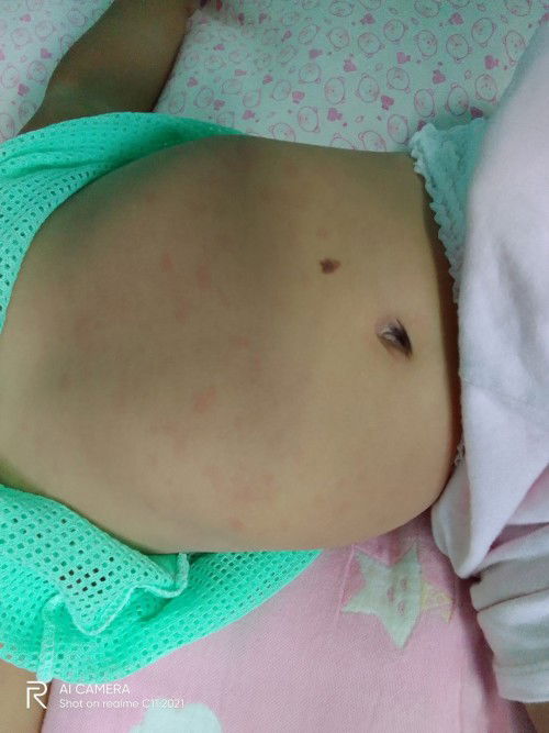 น้อง8เดือน28วันเป็นไข้