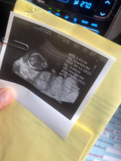 อัลตราซาวด์14w