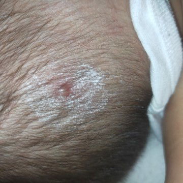 Hi mommies Ask ko sana kng my idea kayo kng ano tong parang pimple natubo sa ulo ni baby and kng ano