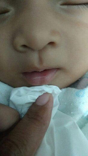 Luka di bibir bayi seperti sariawan