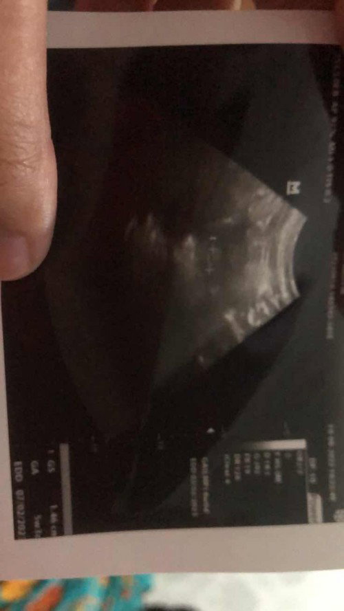 Keluar darah saat usia kandungan 6 minggu