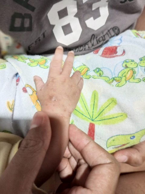 Gatel gatel pada badan