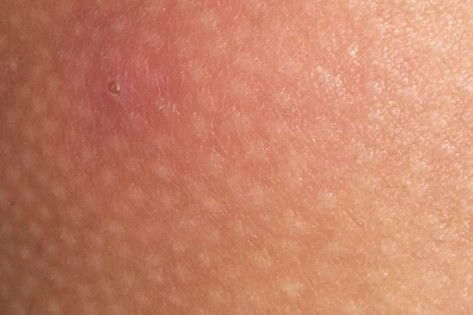 Hello ask ko lang delikado ba sa buntis mag ka pigsa . 26 weeks pregnant po ako.