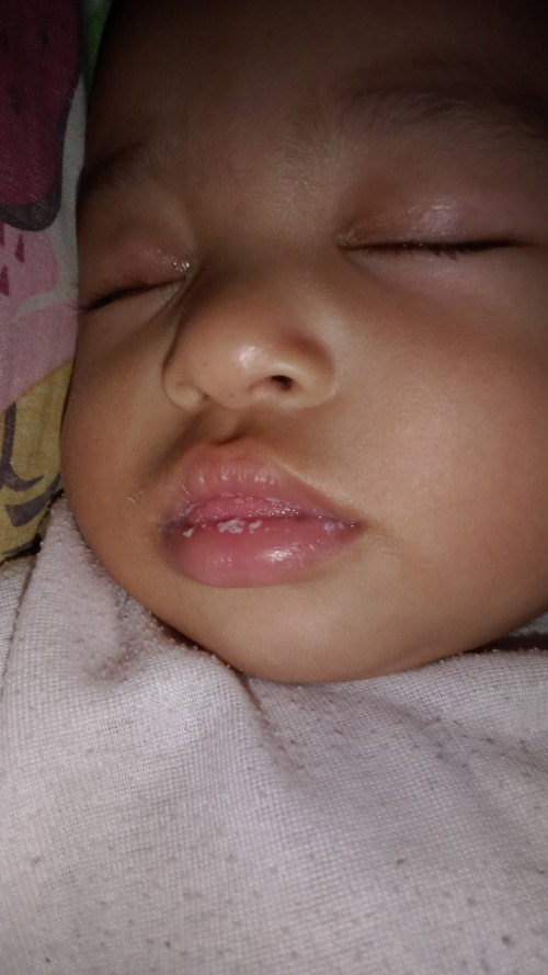 7bulan 17hari bibir seperti sariawan