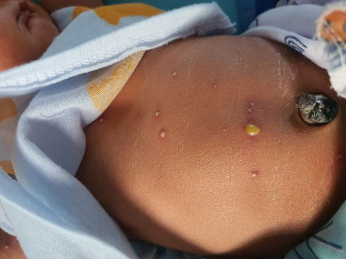 ตุ่มใสน้ำเหลืองขึ้นตามตัว