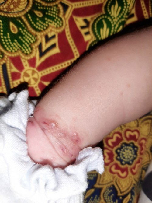 Hai bun,anak saya lagi mengalami gatal gatal pada pergelangan tangan,kira2 obatnya apa yah